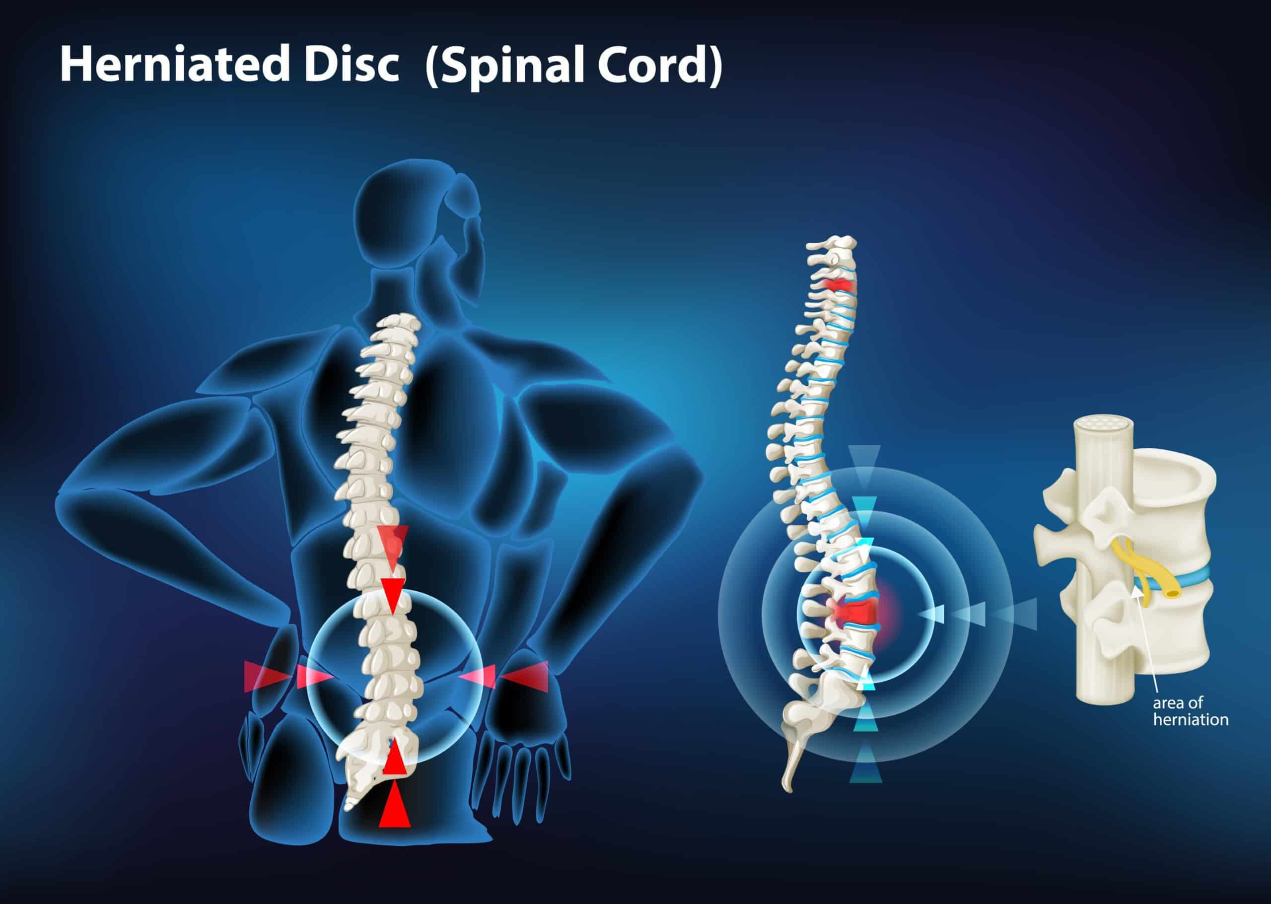 A new hope to treat Flat Tire in Spine: The Tension-Activated Repair Patch (TARP)