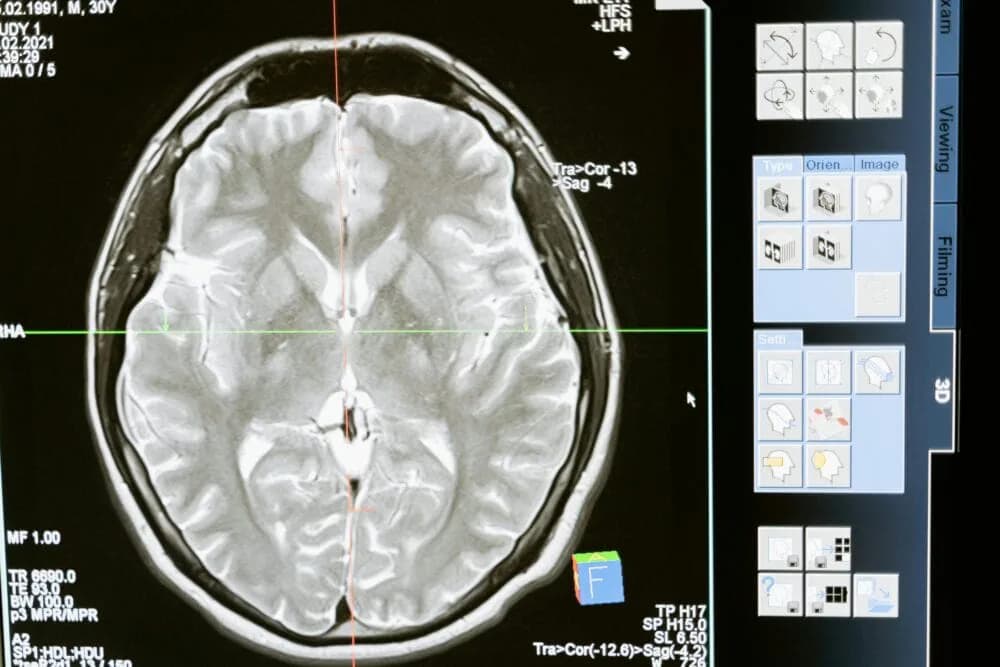 Exploring CAR-T Cell Therapy in Glioblastoma Treatment