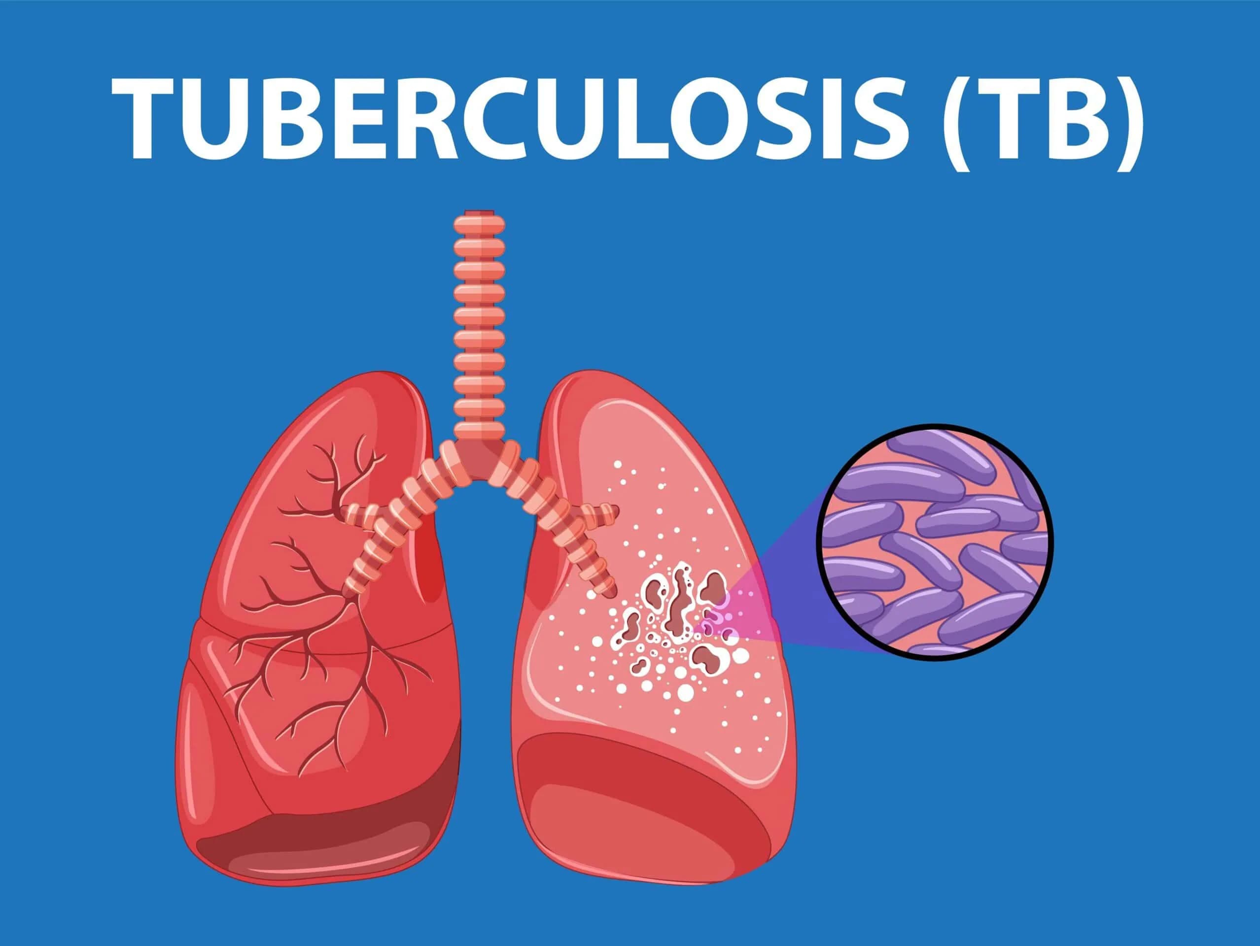 Tuberculosis: Causes, Prevention and Management